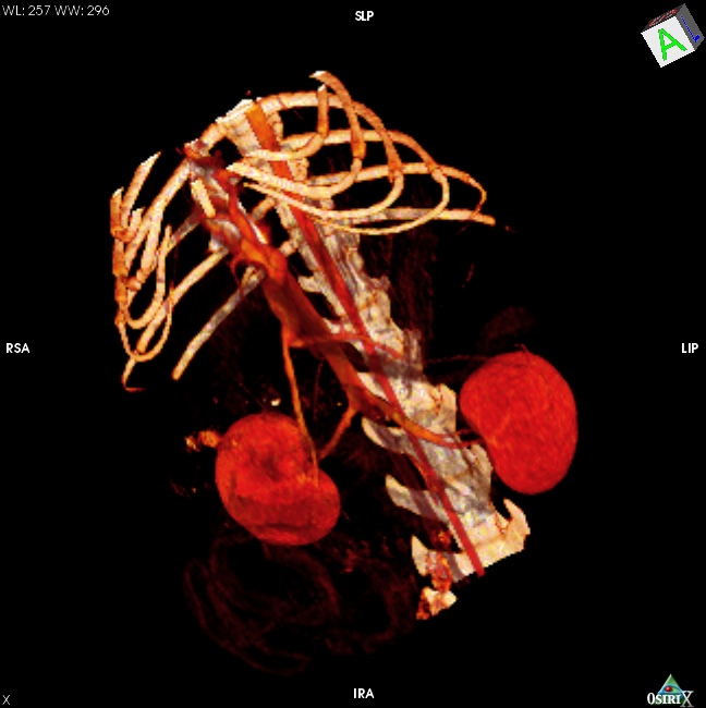 CT - angiografie (koka)