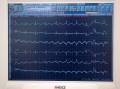 EKG